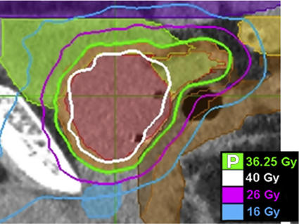 An imaging scan of the prostate and surrounding area depicting an SBRT treatment plan.