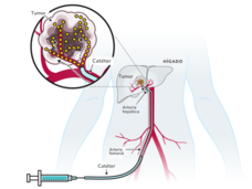 Ilustración de una terapia en la que se infunde un medicamento por una arteria para que fluya hasta el tumor en el cáncer del hígado.