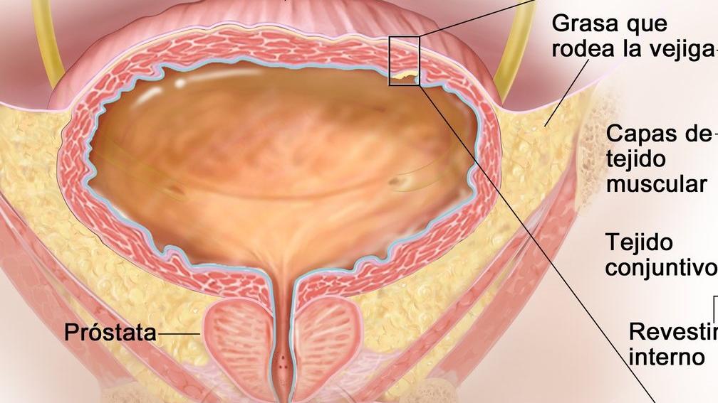 Ilustración del cáncer de vejiga en estadio I,